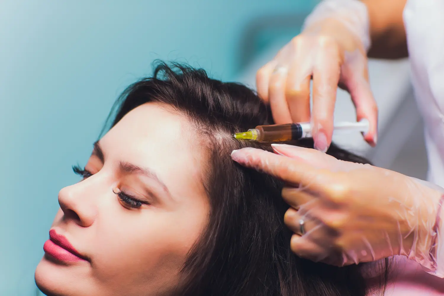 Verfahren zur Injektion von plättchenreichem Plasma. Stimulierung des Haarwachstums. Ablauf der PRP-Therapie.